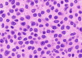 Microscopic view of glioblastoma brain tumour cells under research study