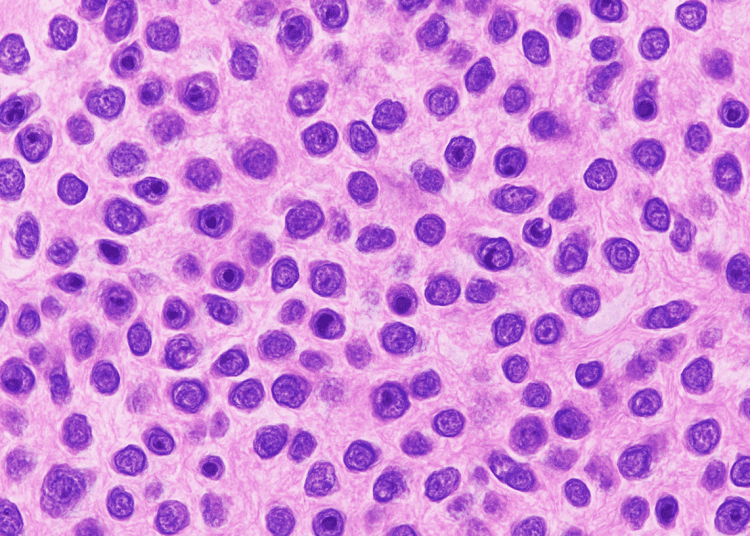 Microscopic view of glioblastoma brain tumour cells under research study