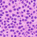 Microscopic view of glioblastoma brain tumour cells under research study