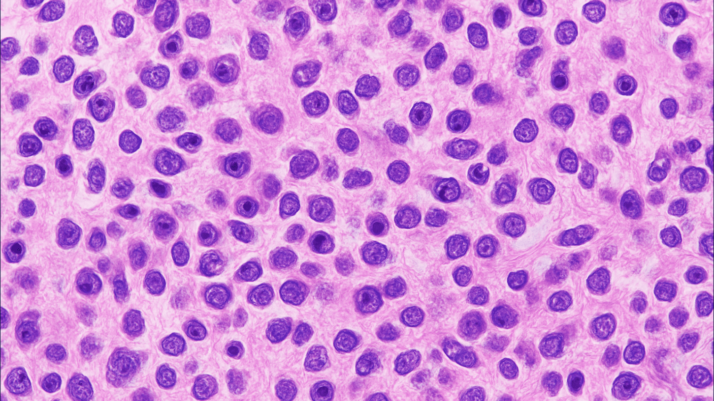 Microscopic view of glioblastoma brain tumour cells under research study